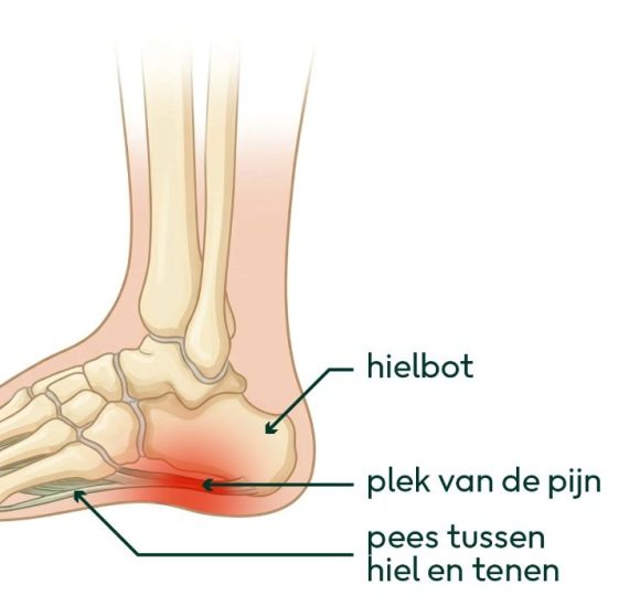 hielspoor behandeling fysio alblasserwaard